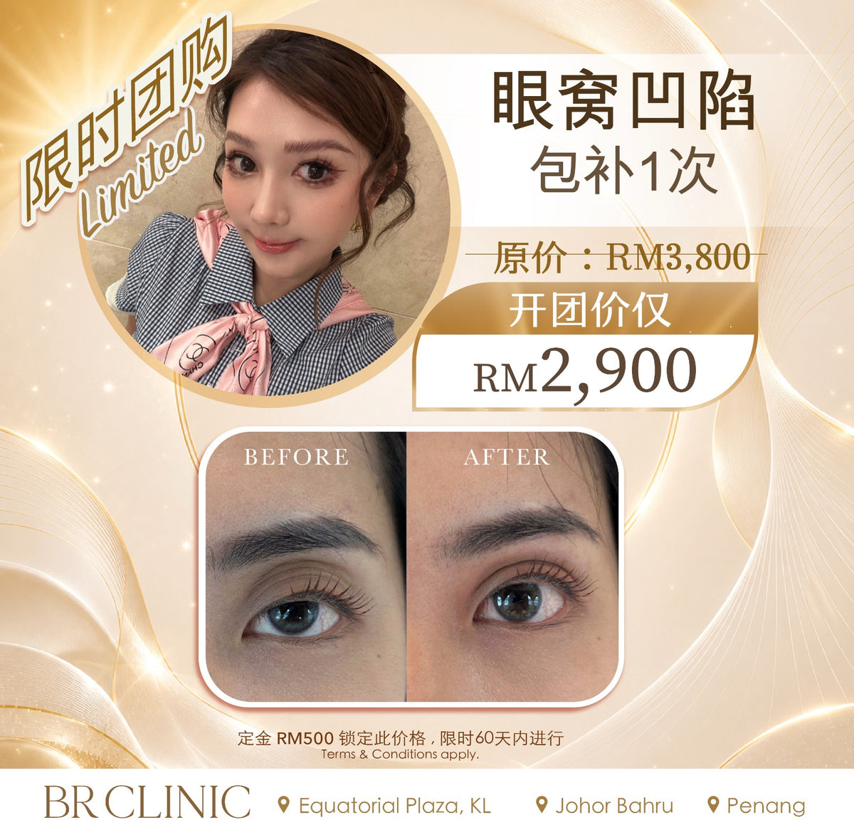 Beautrice 十月开团:- Sunken Eye Revival Treatment (T&C applies)
